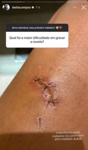 Atriz posta foto da perna após ser mordida por jacaré em gravação de novela; IMAGEM FORTE