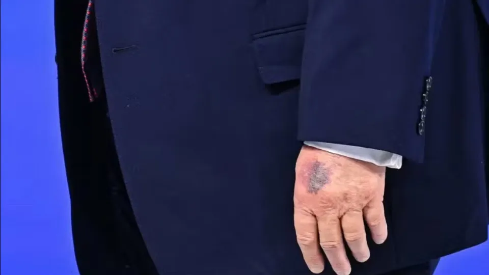 Hematoma misterioso na mão de Trump volta a chamar a atenção