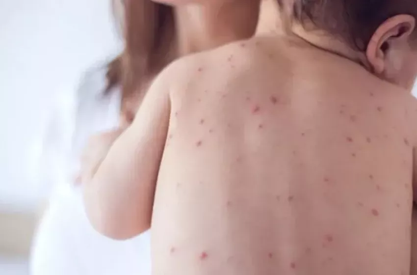 Caso de meningite em escola de Maceió é confirmado como viral