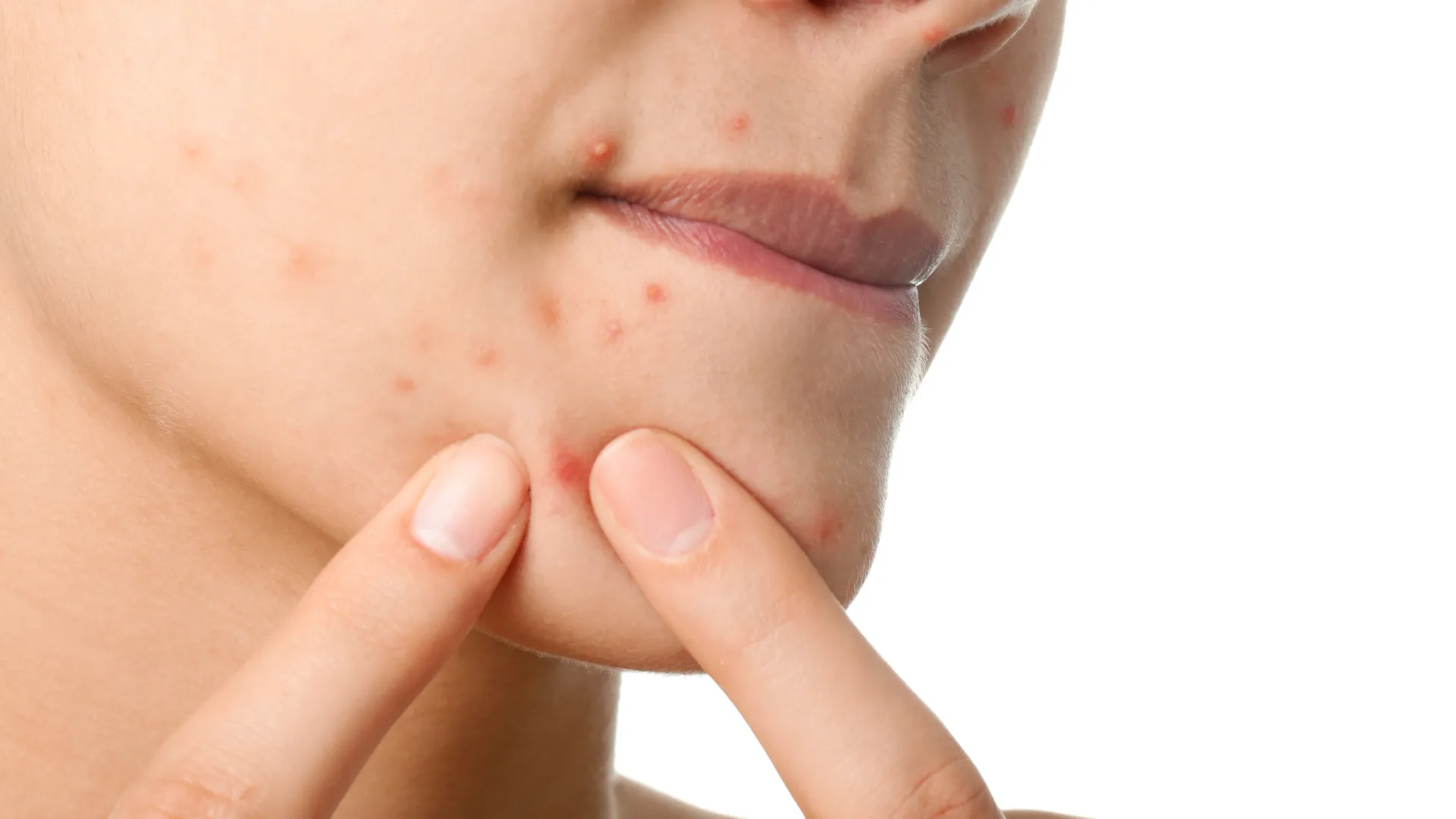 Os 3 piores alimentos para a pele: Os primeiros efeitos aparecem no rosto