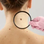 Câncer: estudo alerta para riscos de melanoma fora da pele